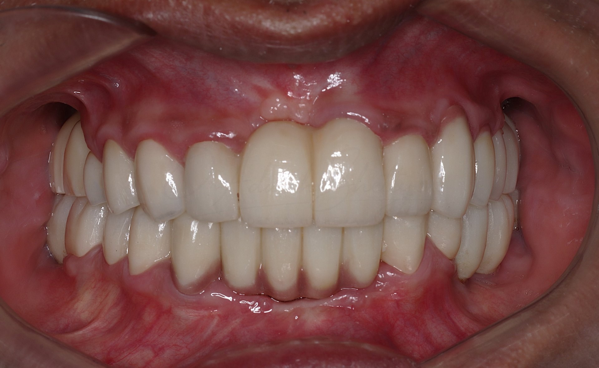 FMR Case 1 After