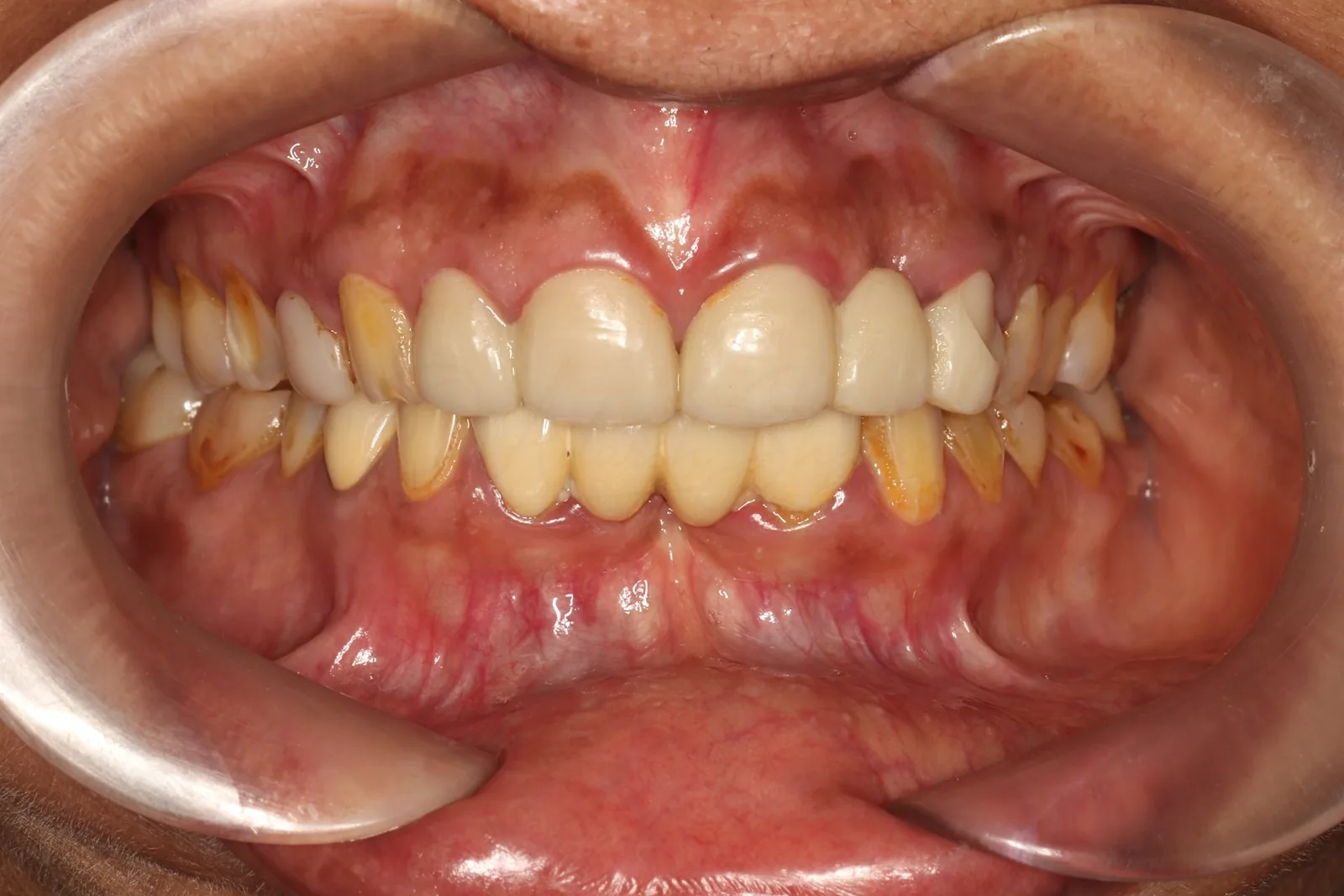 FMR Case 2 Before