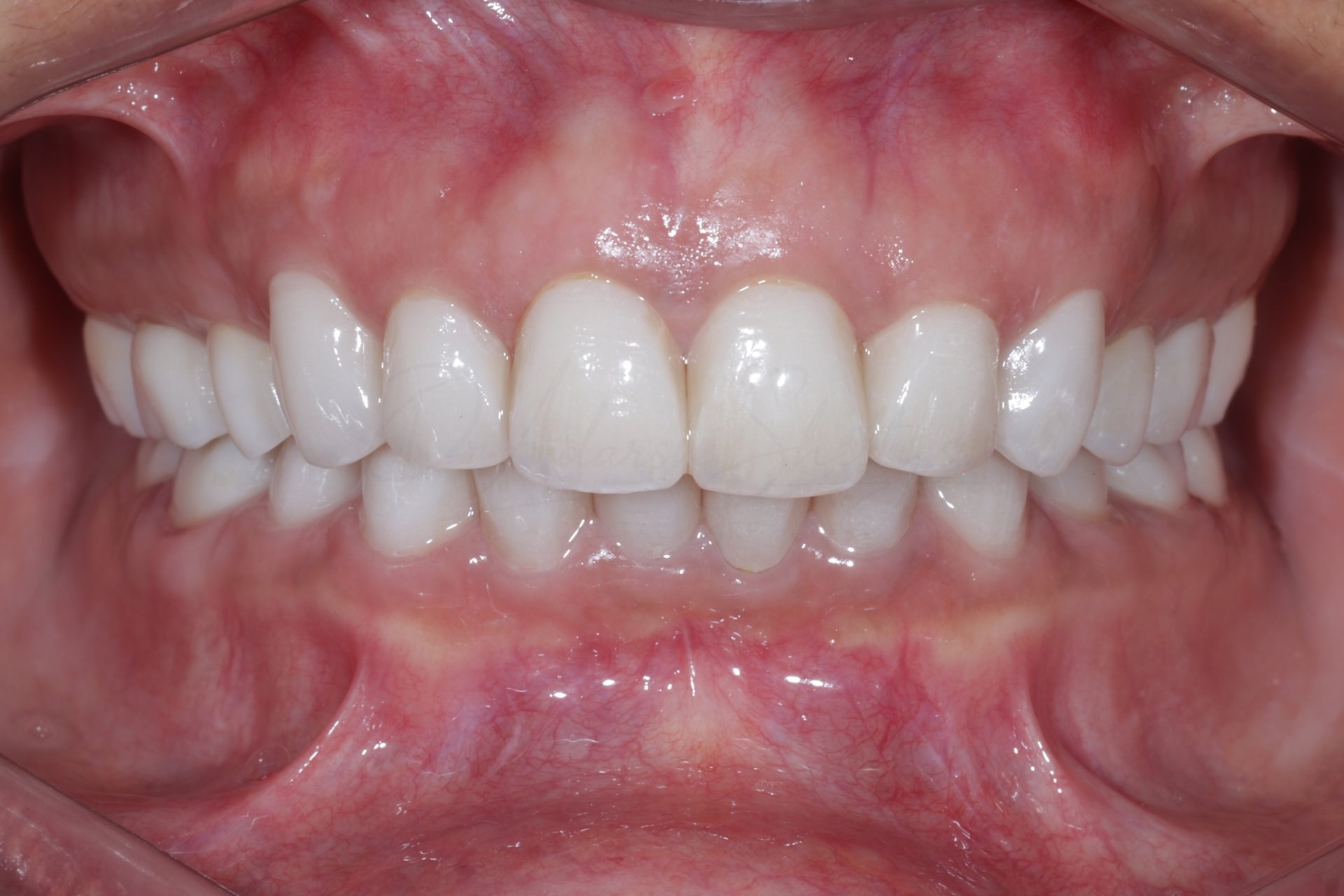 FMR Case 3 Before