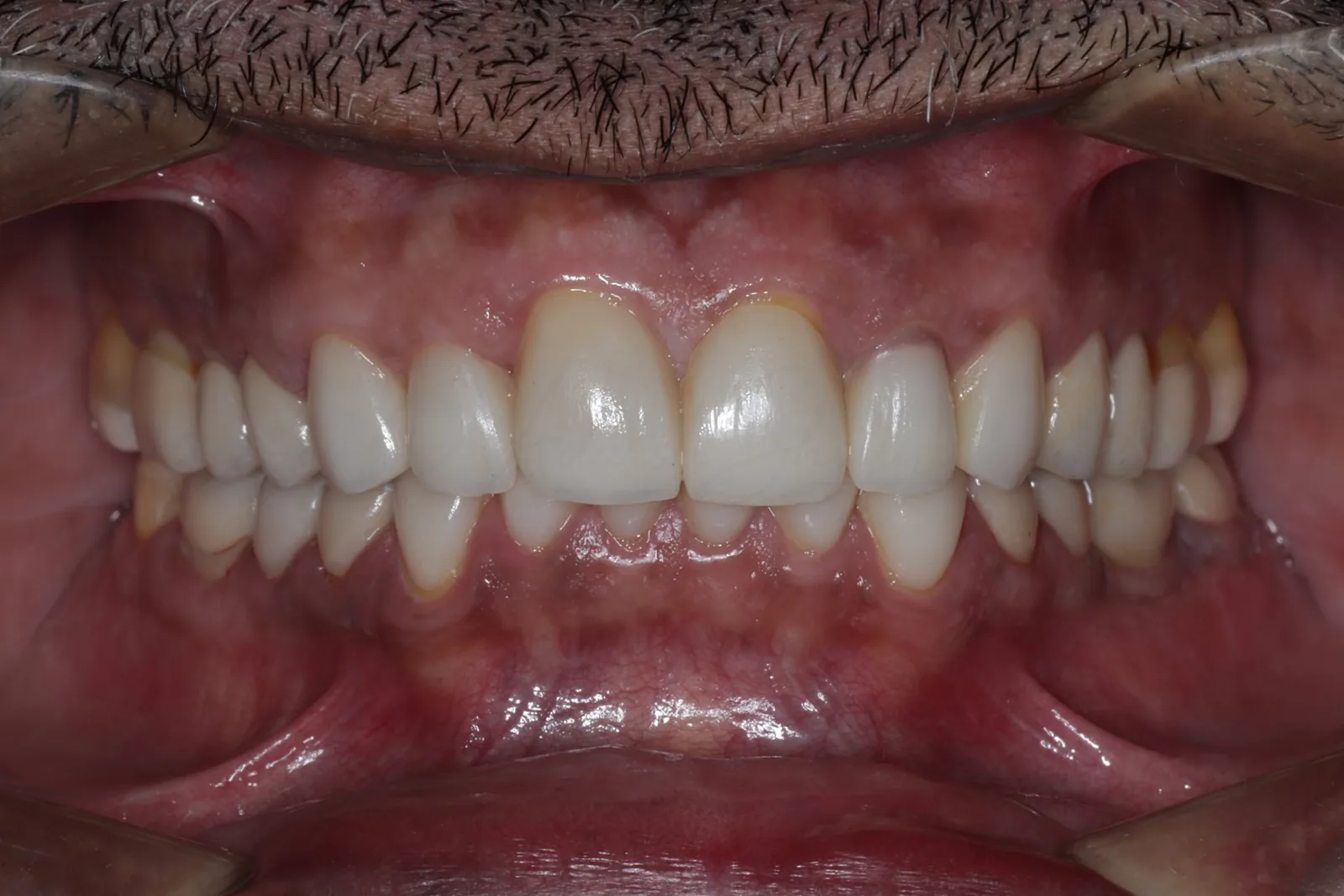 FMR Case 3 After