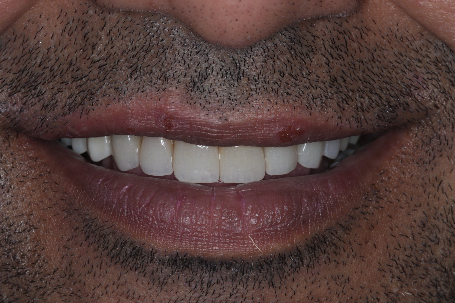 Smile Case 1 After