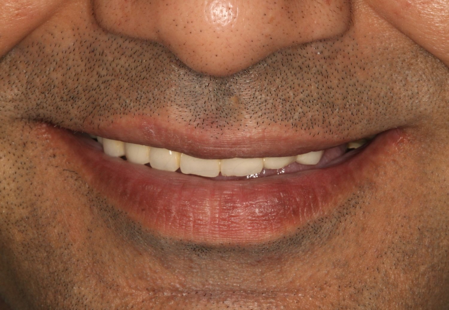 Smile Case 1 Before