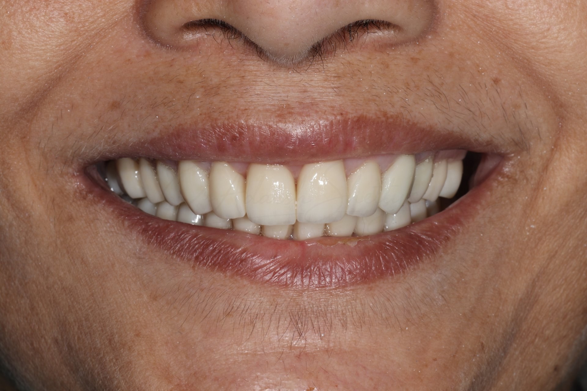 Smile Case 2 After