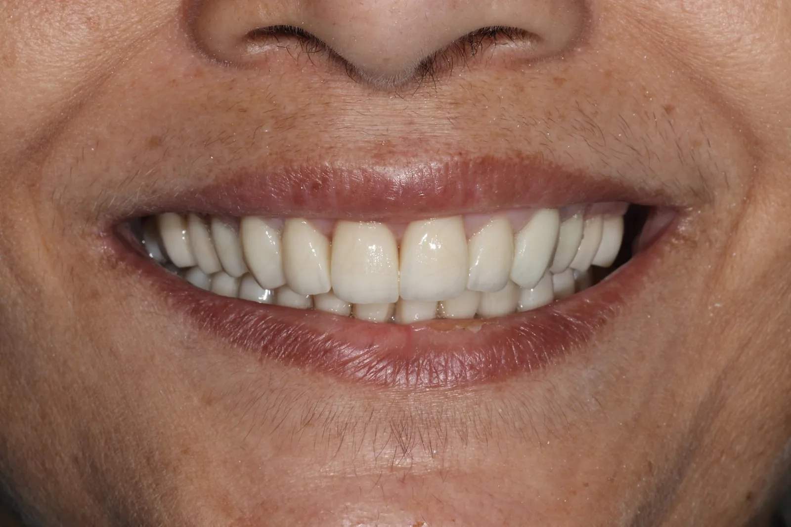 Smile Case 2 After