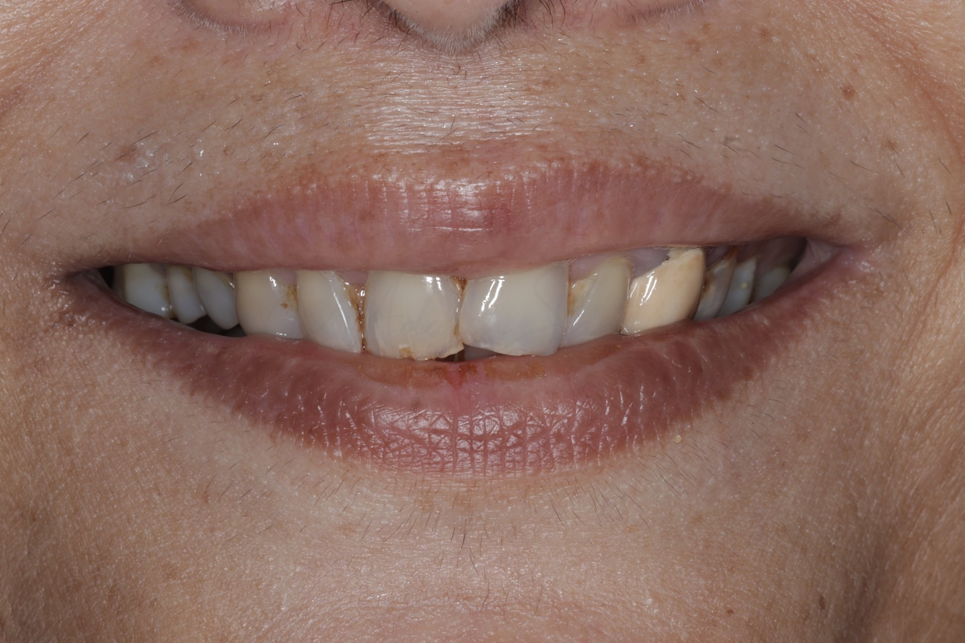 Smile Case 2 Before