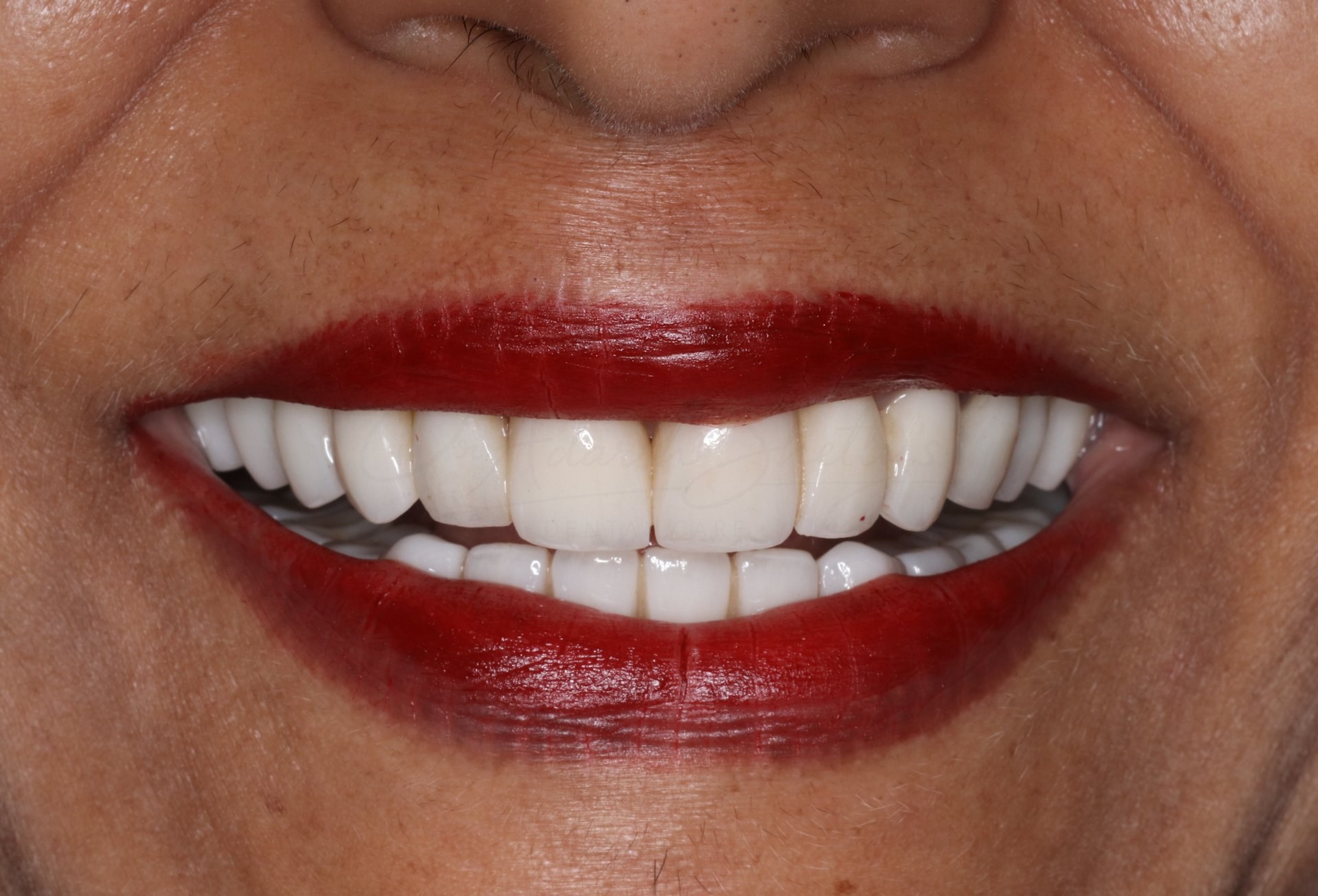 Smile Case 3 After
