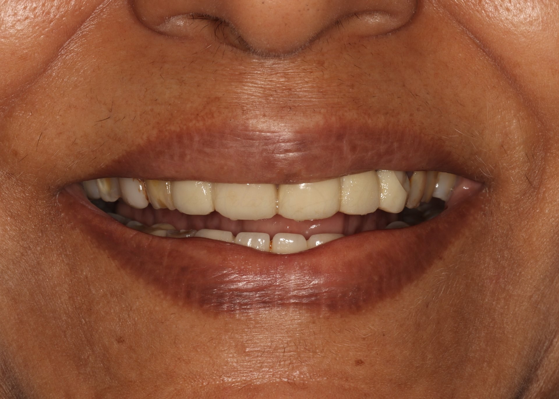 Smile Case 3 Before