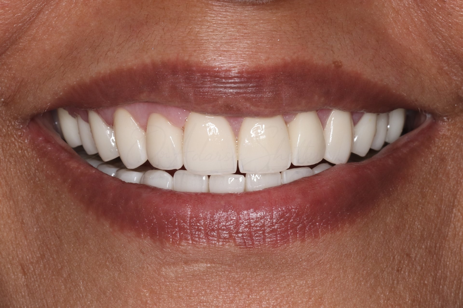 Smile Designing Case 4 After