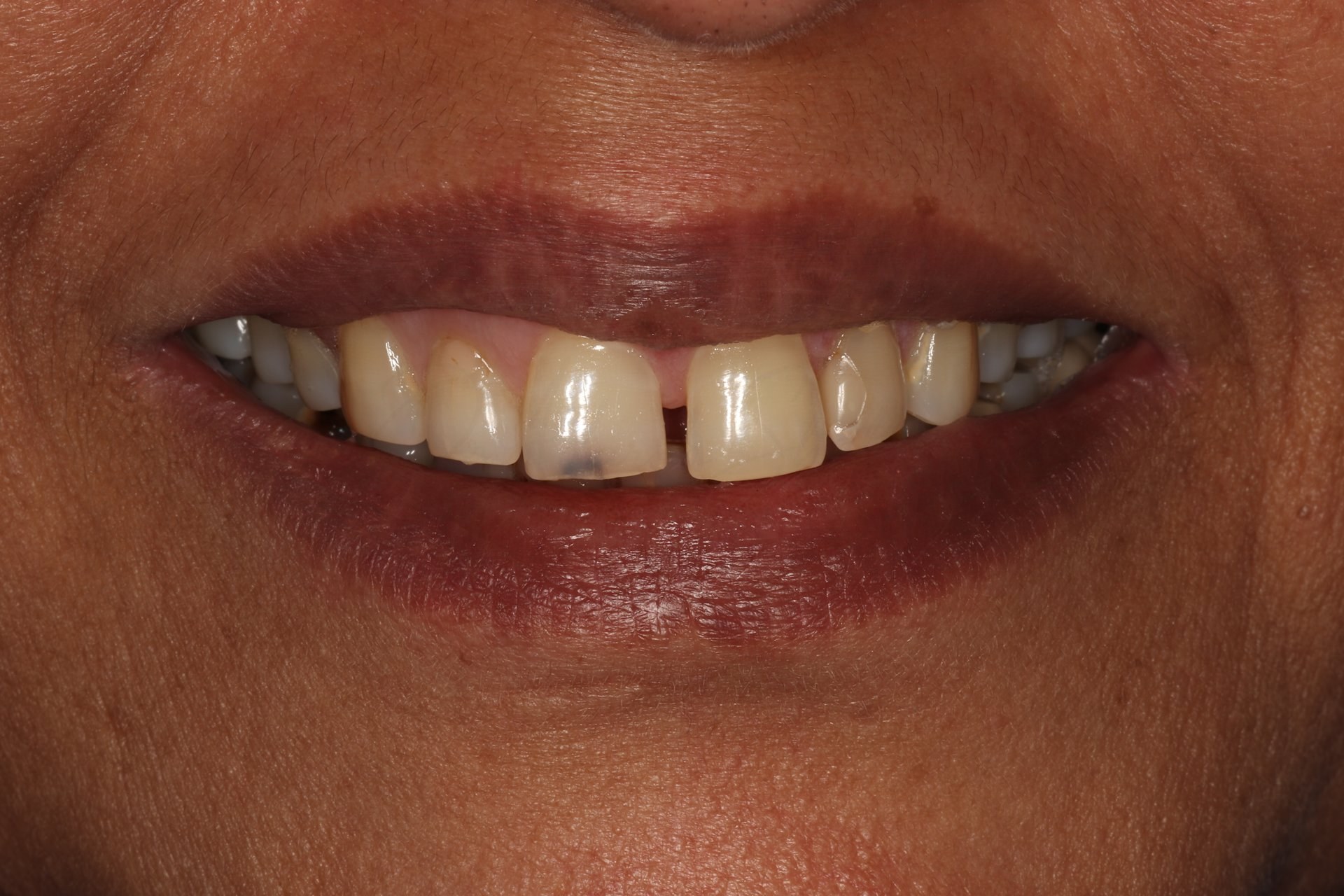 Smile Designing Case 4 Before