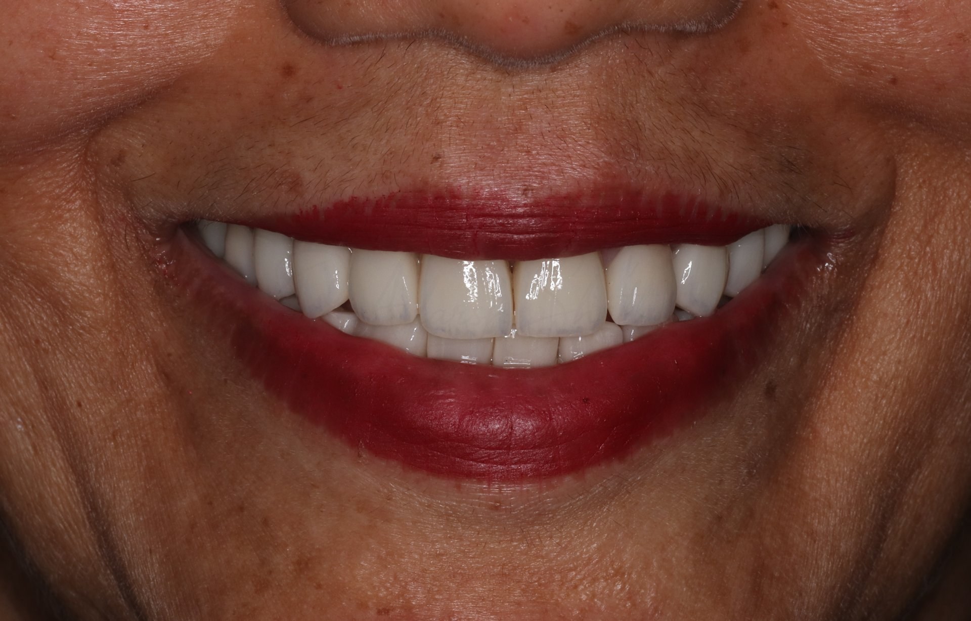 Smile Designing Case 5 After