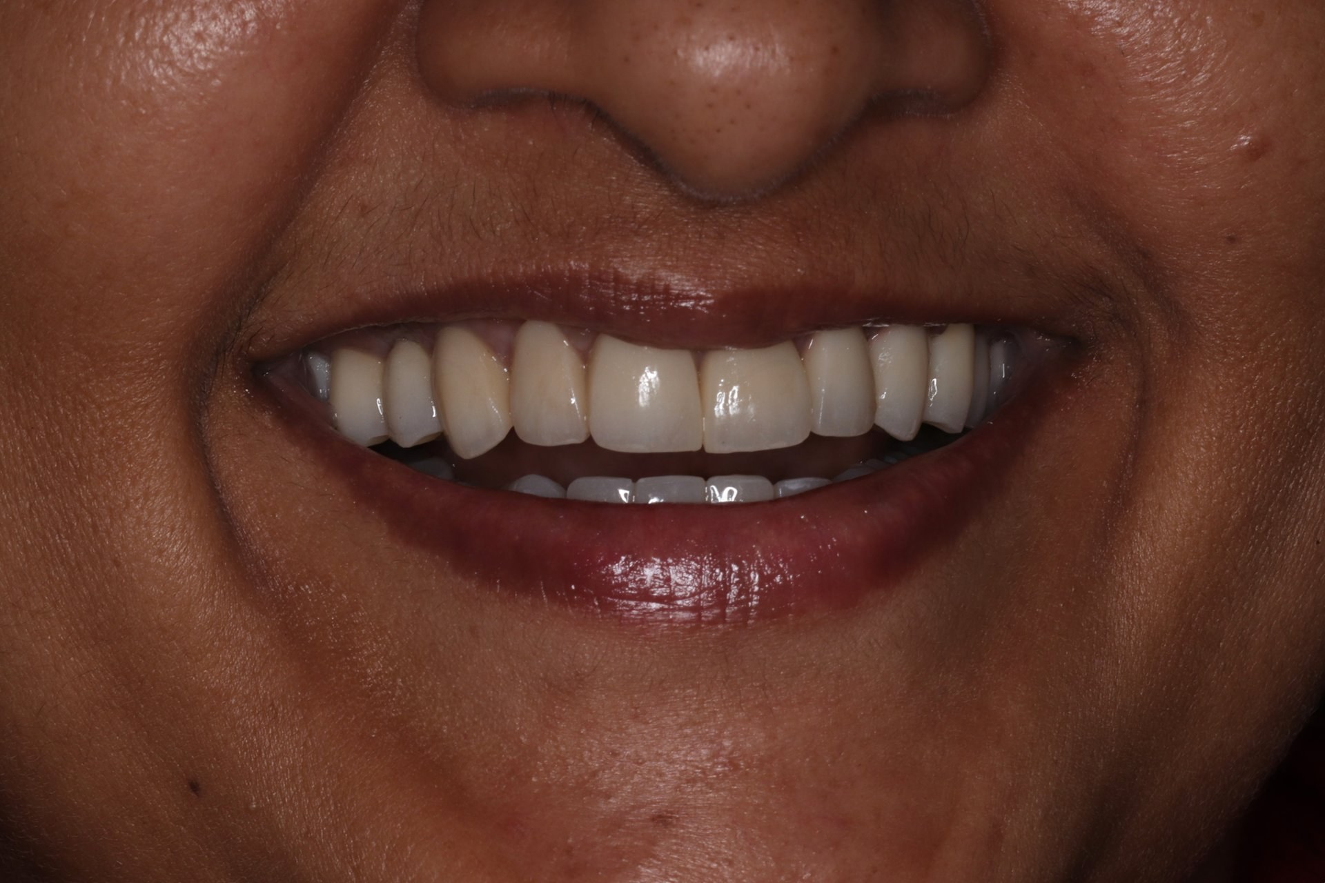 Smile Designing Case 6 After