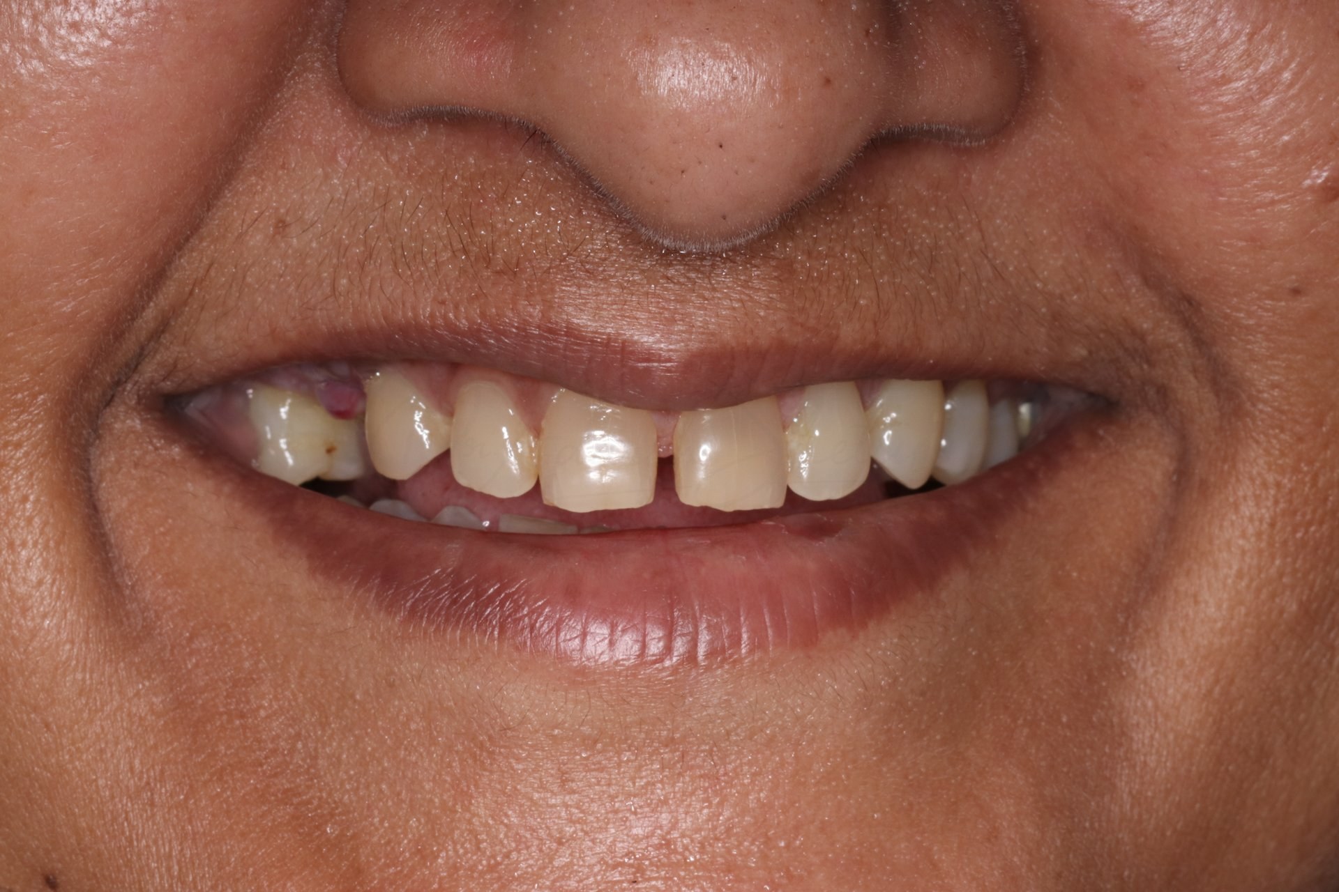 Smile Designing Case 6 Before