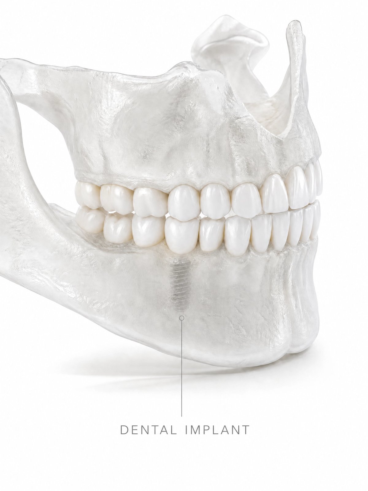 Dental Implants in Mira Road, Mumbai