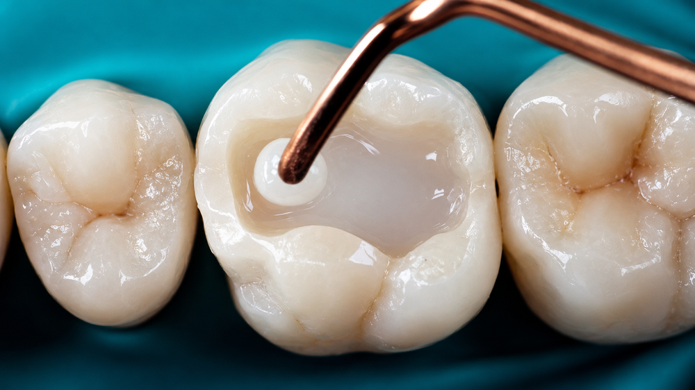 Dental Fillings