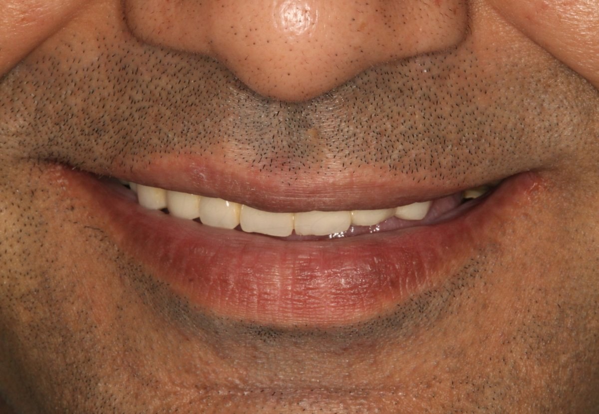 Smile Designing Case 1 Before
