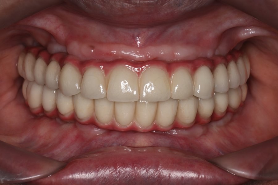 Full Mouth Rehabilitation Case After