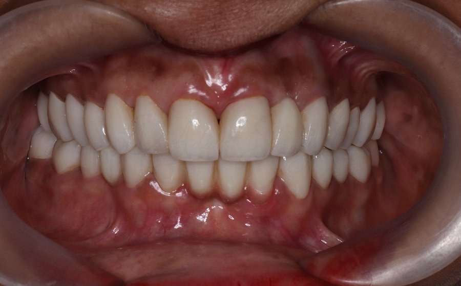 Full Mouth Rehabilitation Case 3 After